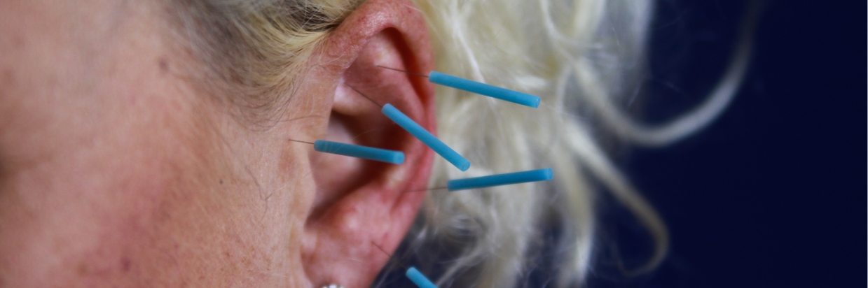 Auricular acupuncture 