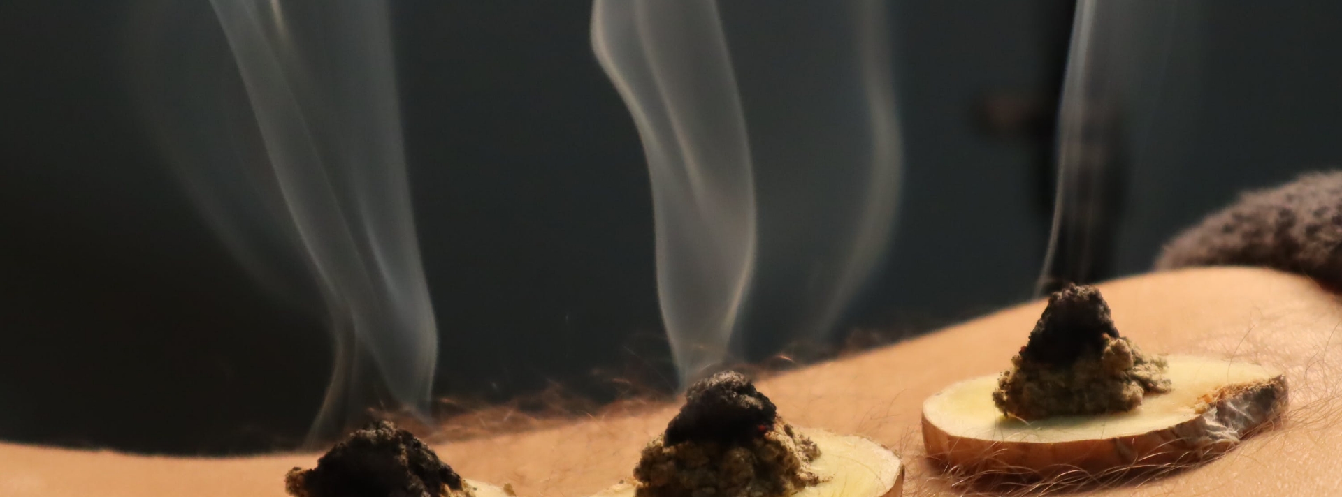 Moxibustion