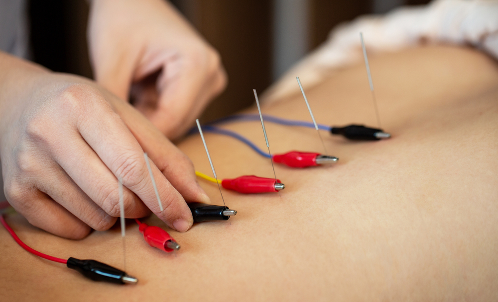 Acupuncture and Electroacupuncture Explained