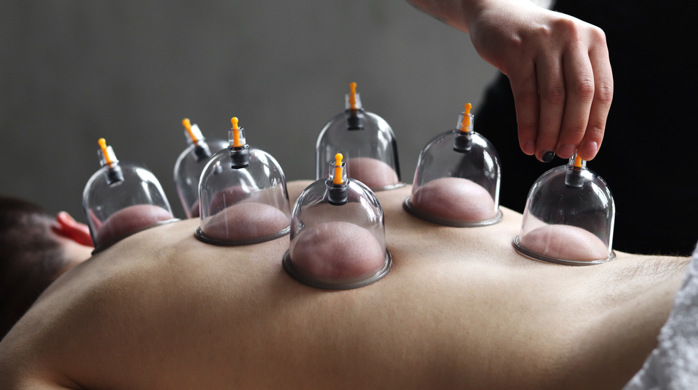 The Benefits of Acupuncture and Cupping Therapy